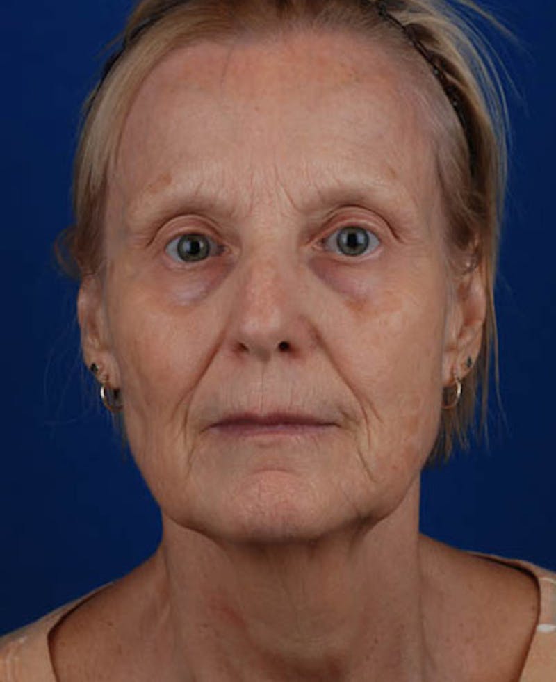 Facelift Before & After Gallery - Patient 12973989 - Image 1
