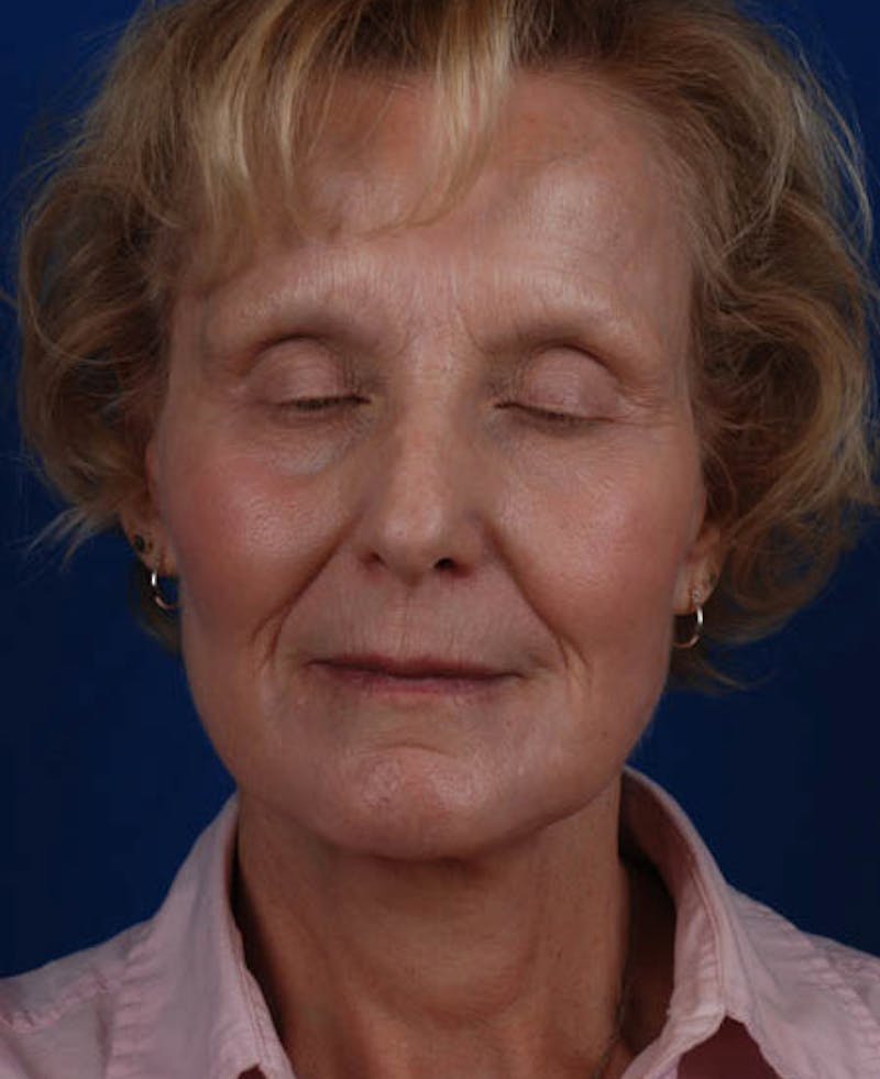 Facelift Before & After Gallery - Patient 12973989 - Image 2