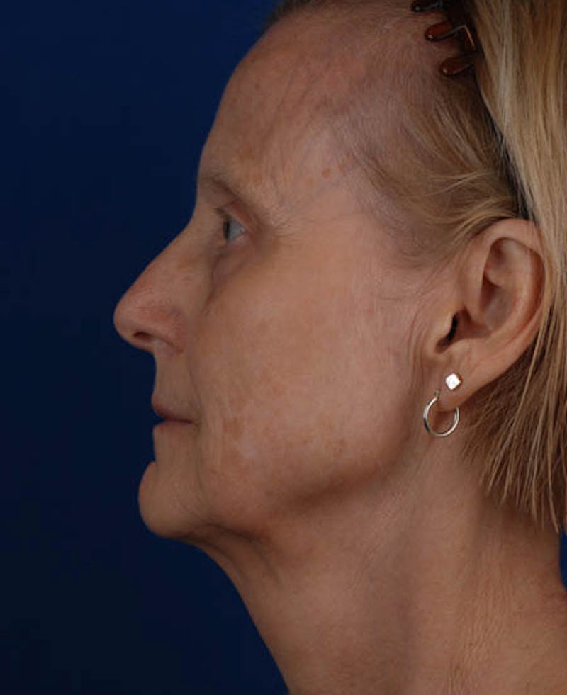 Facelift Before & After Gallery - Patient 12973989 - Image 3