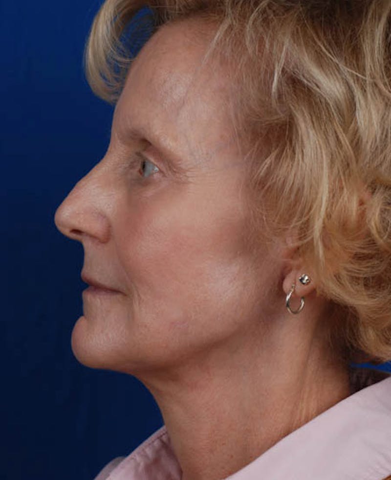 Facelift Before & After Gallery - Patient 12973989 - Image 4