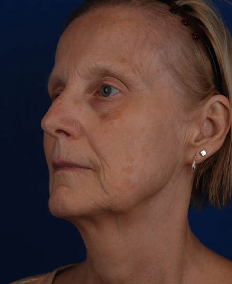 Facelift Before & After Gallery - Patient 12973989 - Image 5