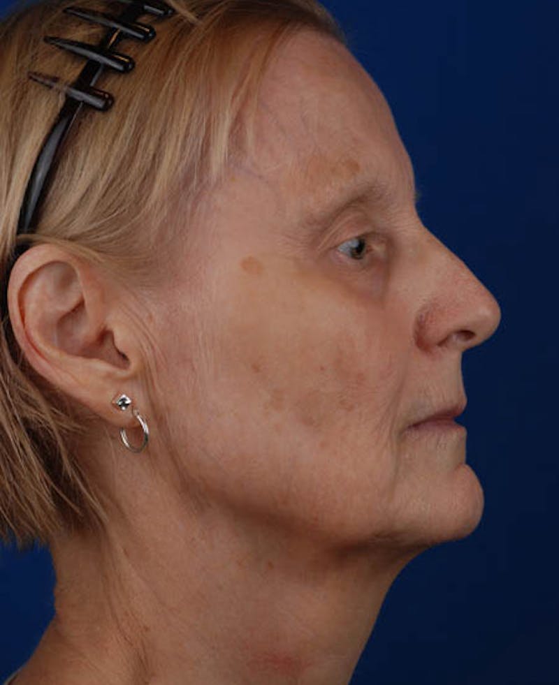 Facelift Before & After Gallery - Patient 12973989 - Image 7