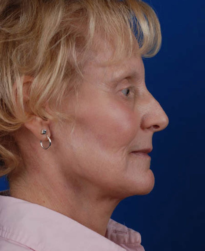 Facelift Before & After Gallery - Patient 12973989 - Image 8