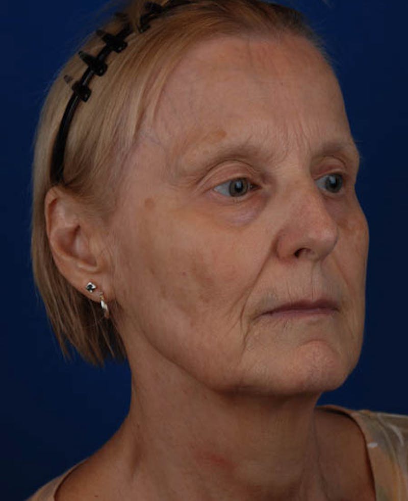 Facelift Before & After Gallery - Patient 12973989 - Image 9