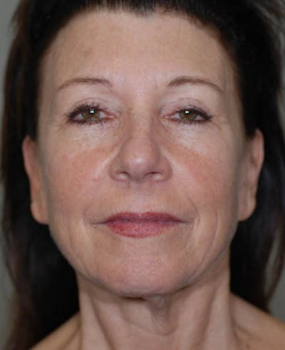Facelift Before & After Gallery - Patient 12973992 - Image 1