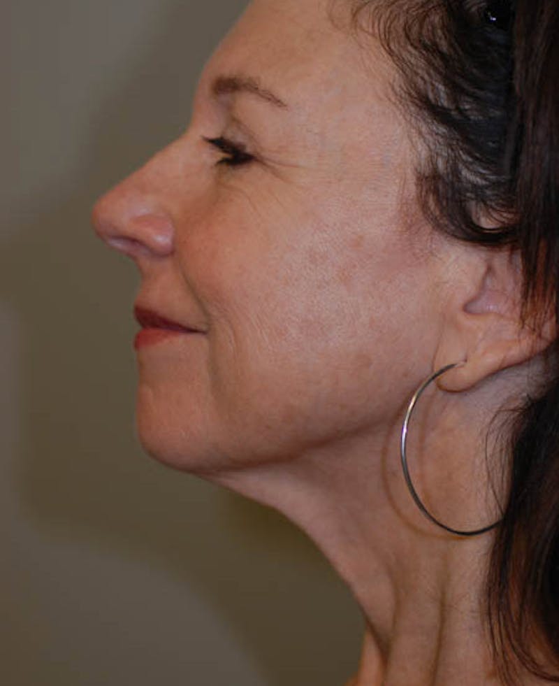 Facelift Before & After Gallery - Patient 12973992 - Image 3