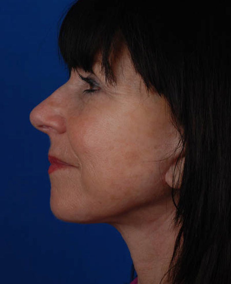Facelift Before & After Gallery - Patient 12973992 - Image 4