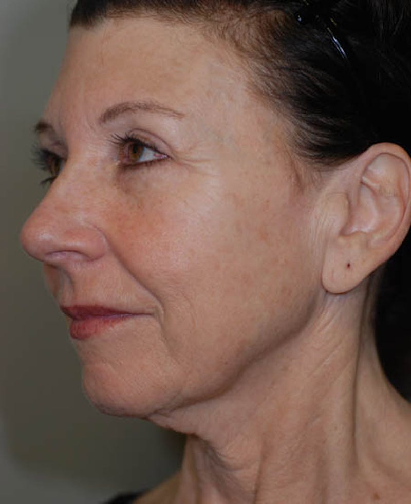 Facelift Before & After Gallery - Patient 12973992 - Image 5