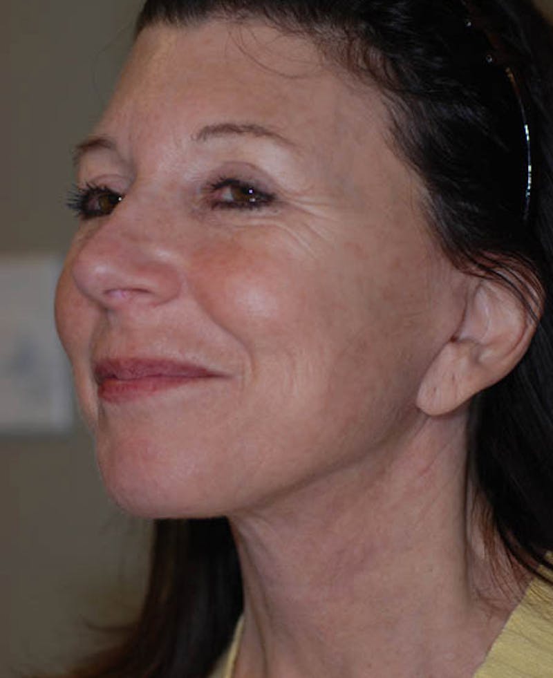 Facelift Before & After Gallery - Patient 12973992 - Image 6