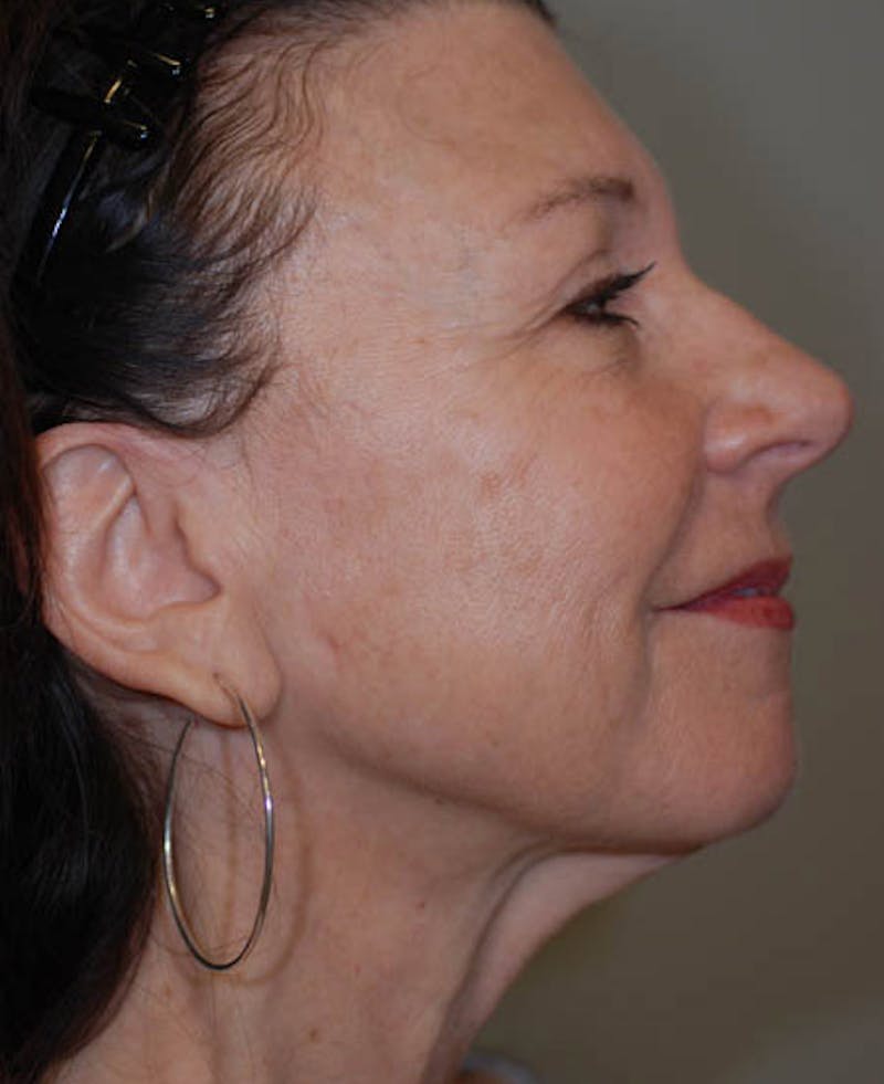 Facelift Before & After Gallery - Patient 12973992 - Image 7
