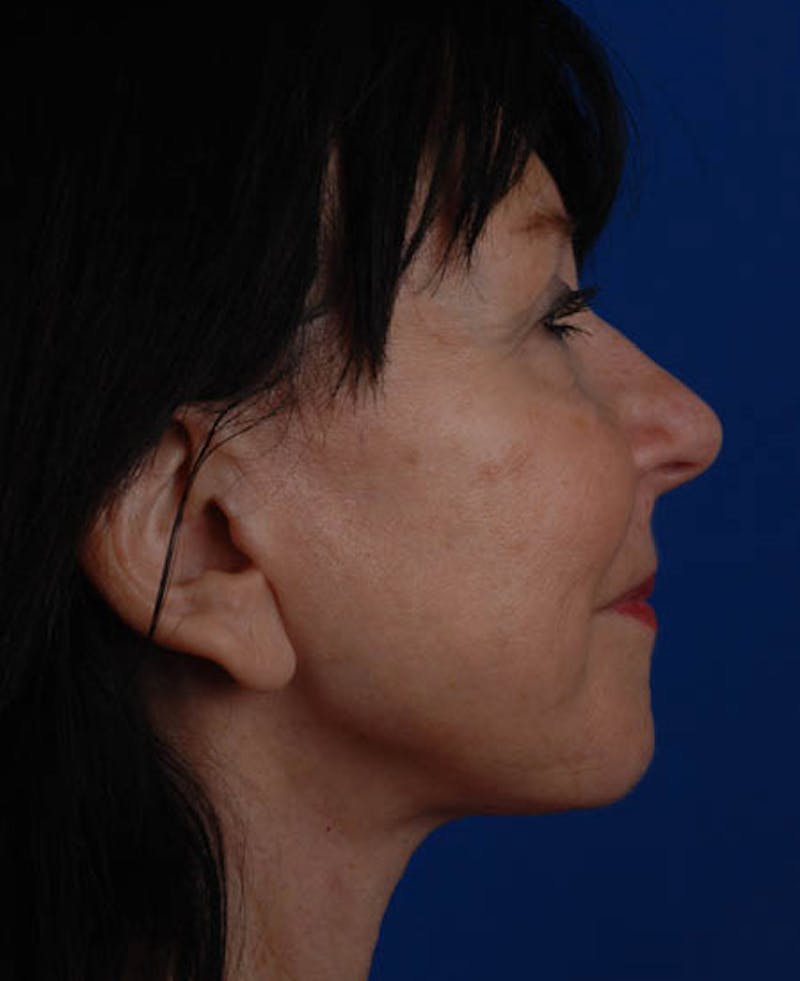 Facelift Before & After Gallery - Patient 12973992 - Image 8