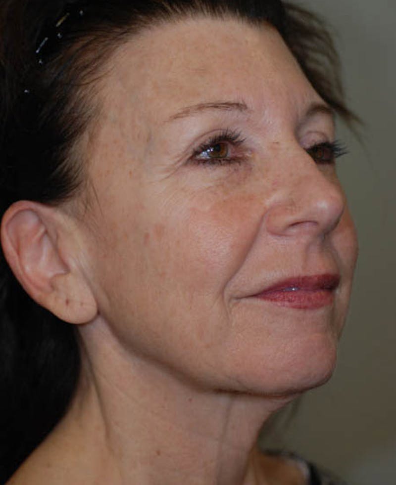 Facelift Before & After Gallery - Patient 12973992 - Image 9