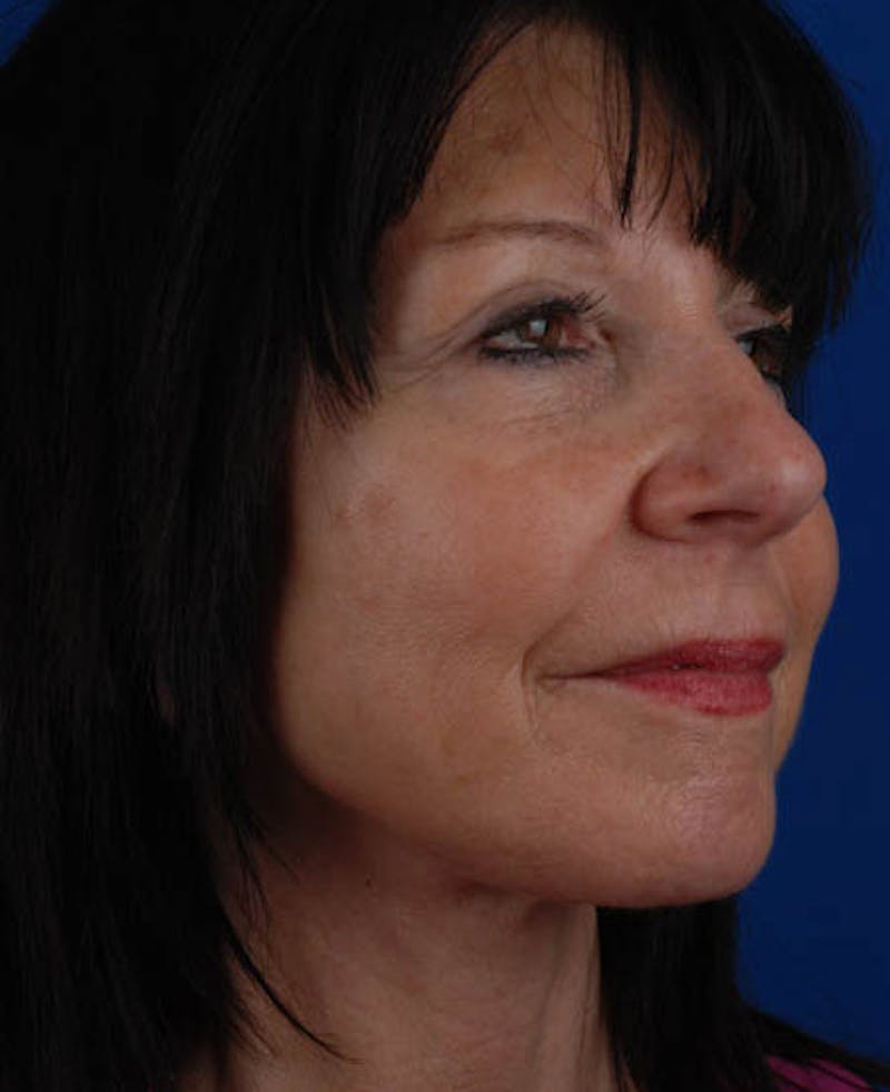 Facelift Before & After Gallery - Patient 12973992 - Image 10