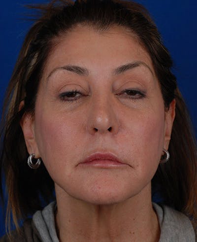 Facelift Before & After Gallery - Patient 12973996 - Image 1