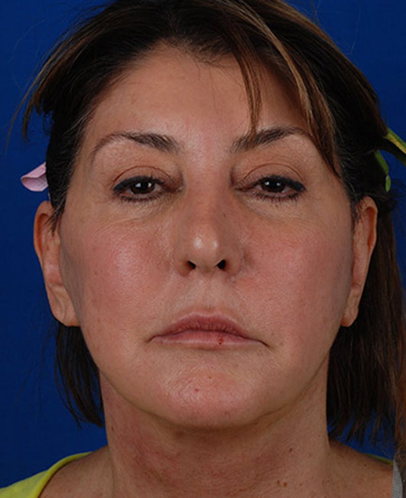 Facelift Before & After Gallery - Patient 12973996 - Image 2