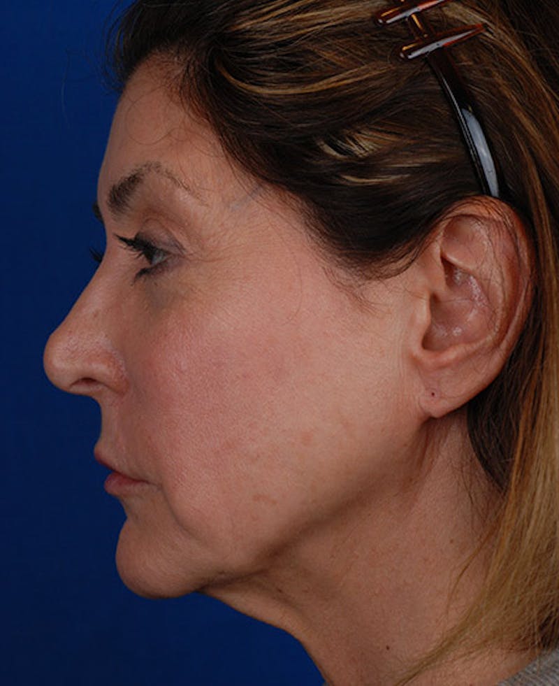Facelift Before & After Gallery - Patient 12973996 - Image 3