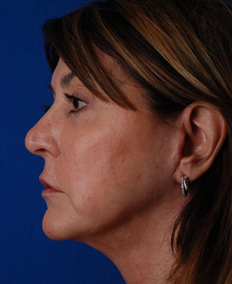 Facelift Before & After Gallery - Patient 12973996 - Image 4