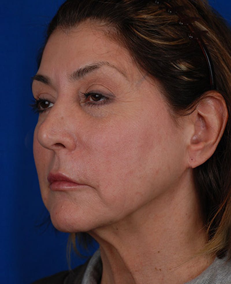 Facelift Before & After Gallery - Patient 12973996 - Image 5