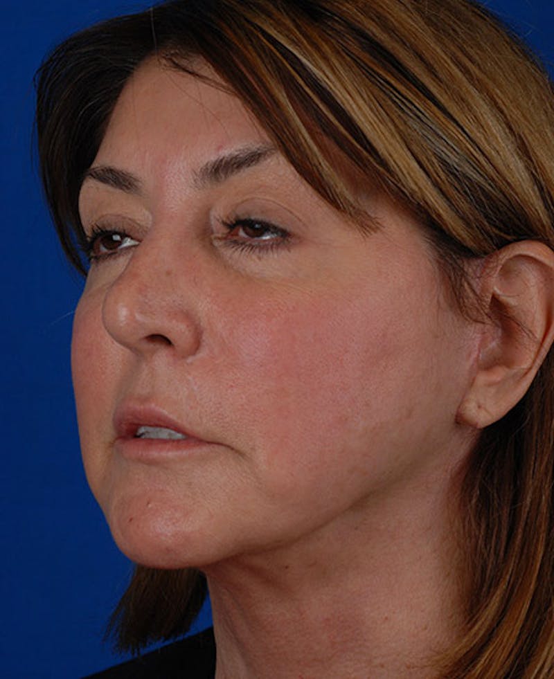Facelift Before & After Gallery - Patient 12973996 - Image 6