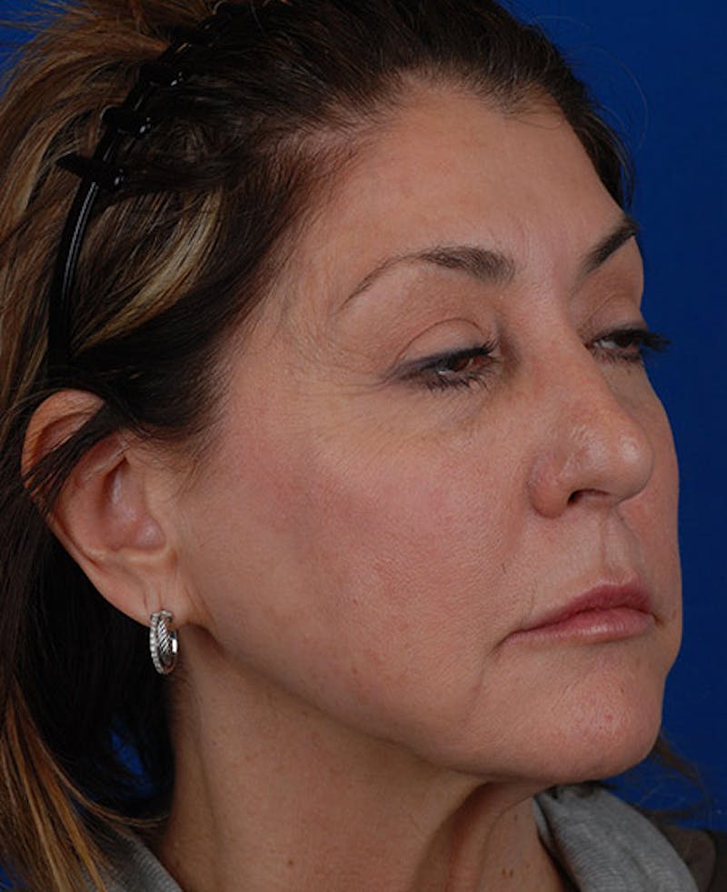 Facelift Before & After Gallery - Patient 12973996 - Image 7