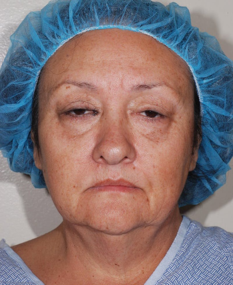 Facelift Before & After Gallery - Patient 12973998 - Image 1