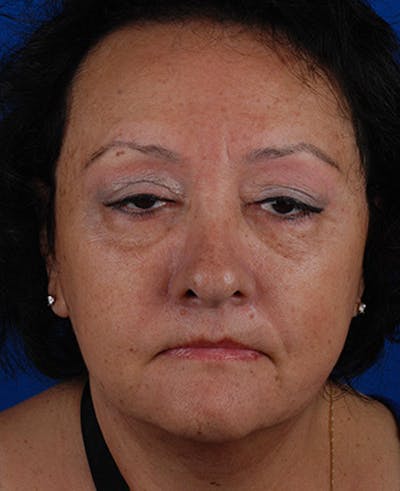 Facelift Before & After Gallery - Patient 12973998 - Image 2