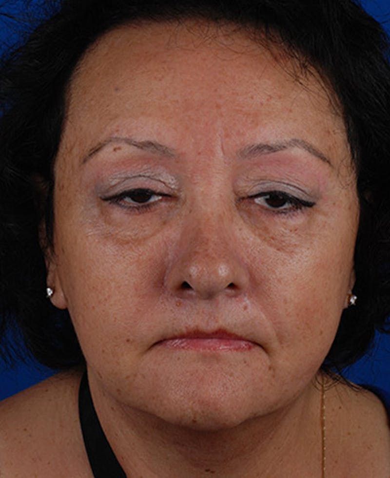 Facelift Before & After Gallery - Patient 12973998 - Image 2
