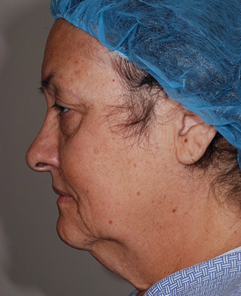 Facelift Before & After Gallery - Patient 12973998 - Image 3