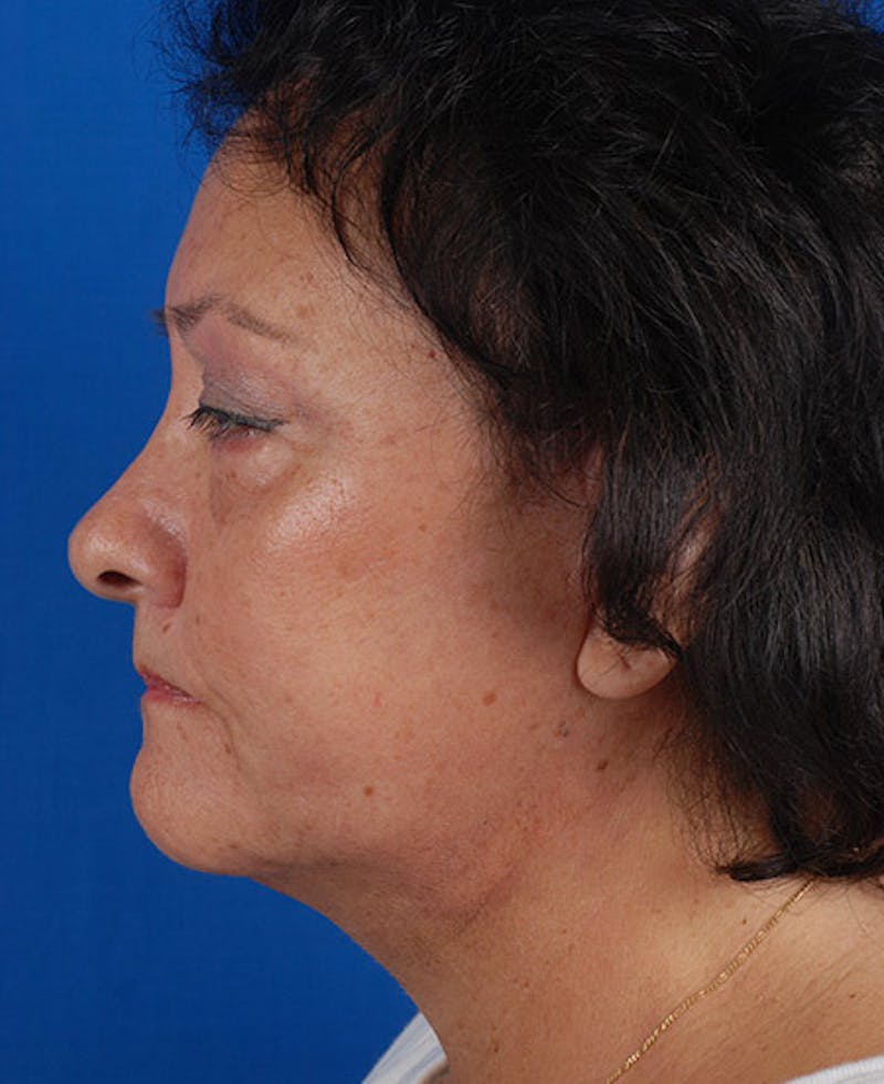 Facelift Before & After Gallery - Patient 12973998 - Image 4