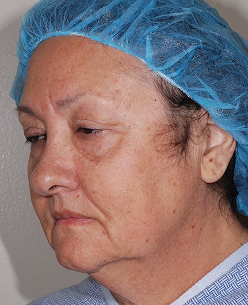 Facelift Before & After Gallery - Patient 12973998 - Image 5
