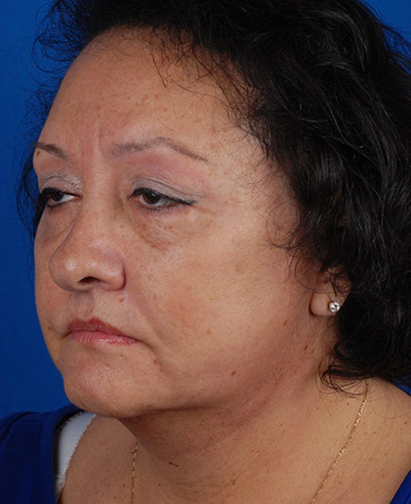 Facelift Before & After Gallery - Patient 12973998 - Image 6
