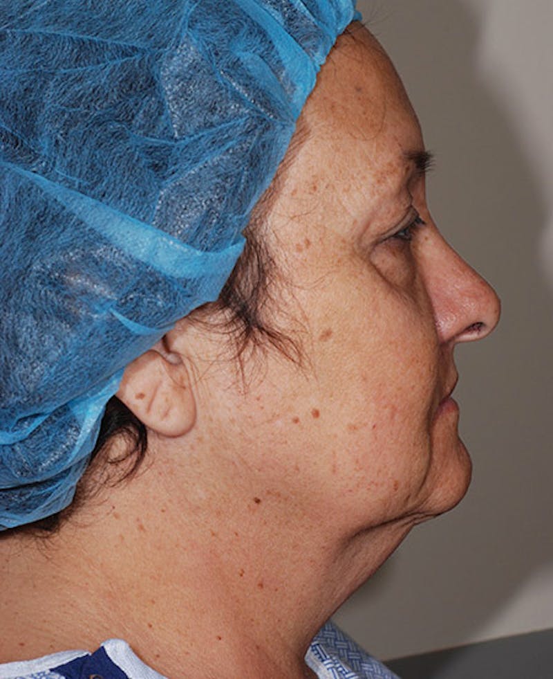 Facelift Before & After Gallery - Patient 12973998 - Image 7