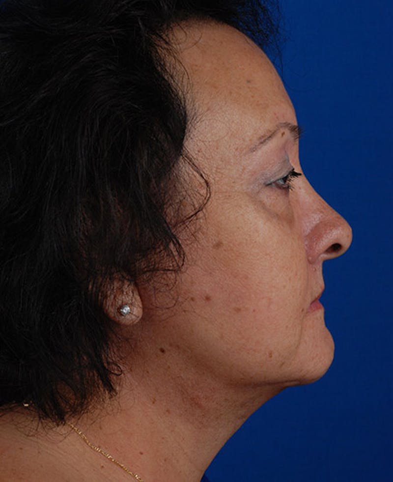 Facelift Before & After Gallery - Patient 12973998 - Image 8