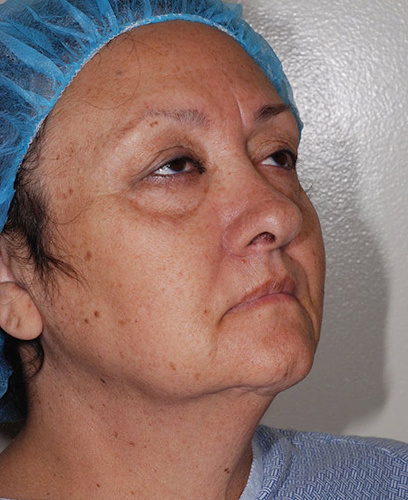Facelift Before & After Gallery - Patient 12973998 - Image 9