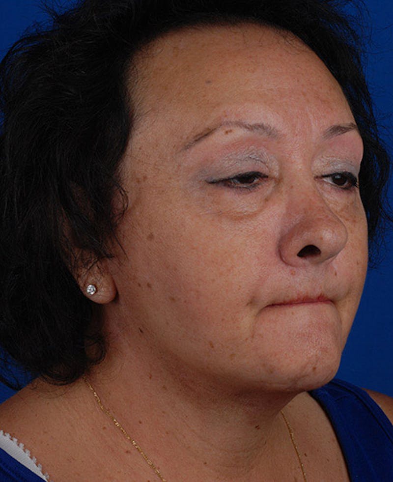 Facelift Before & After Gallery - Patient 12973998 - Image 10