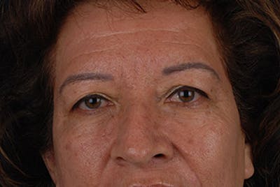 Brow Lift Before & After Gallery - Patient 12974000 - Image 1