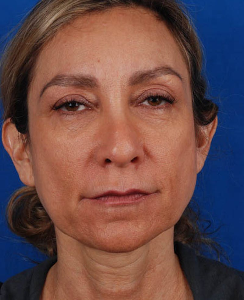Facelift Before & After Gallery - Patient 12974003 - Image 1
