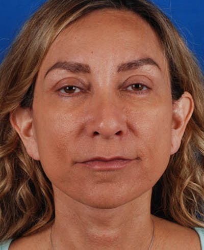 Facelift Before & After Gallery - Patient 12974003 - Image 2