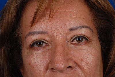 Brow Lift Before & After Gallery - Patient 12974000 - Image 2