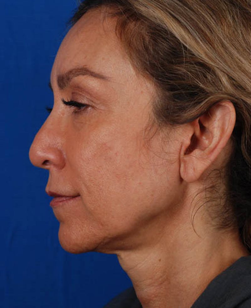 Facelift Before & After Gallery - Patient 12974003 - Image 3