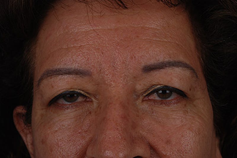 Brow Lift Before & After Gallery - Patient 12974000 - Image 3