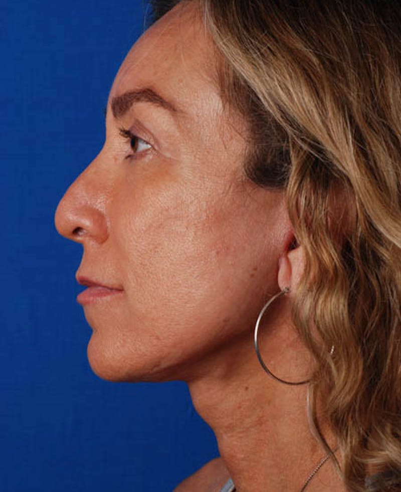 Facelift Before & After Gallery - Patient 12974003 - Image 4