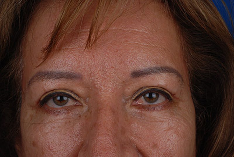 Brow Lift Before & After Gallery - Patient 12974000 - Image 4