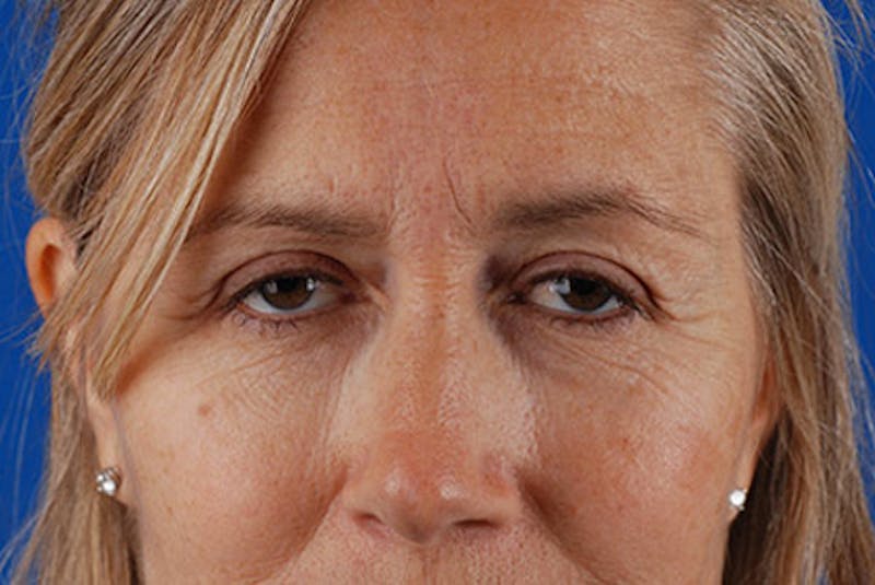 Brow Lift Before & After Gallery - Patient 12974004 - Image 1