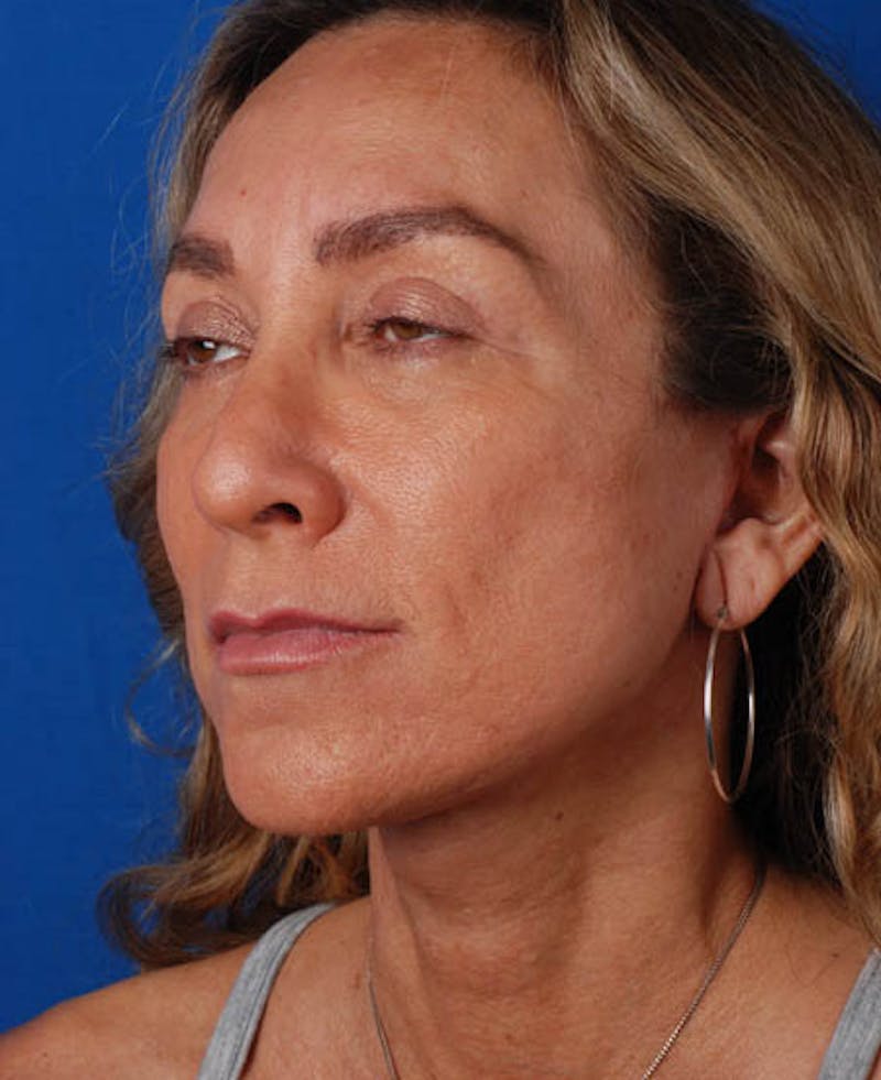 Facelift Before & After Gallery - Patient 12974003 - Image 6