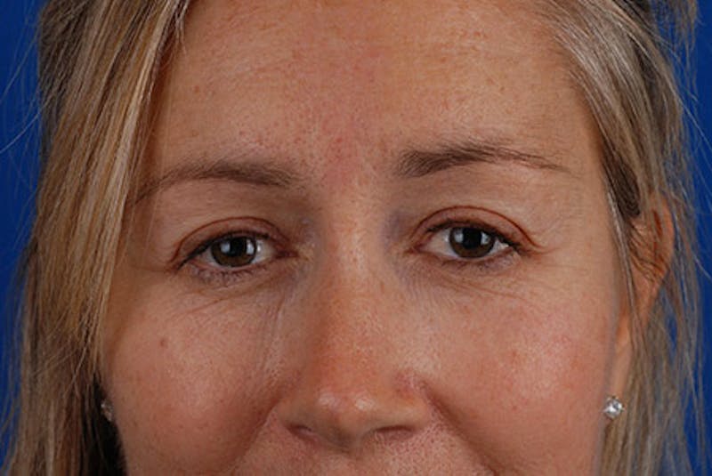 Brow Lift Before & After Gallery - Patient 12974004 - Image 2