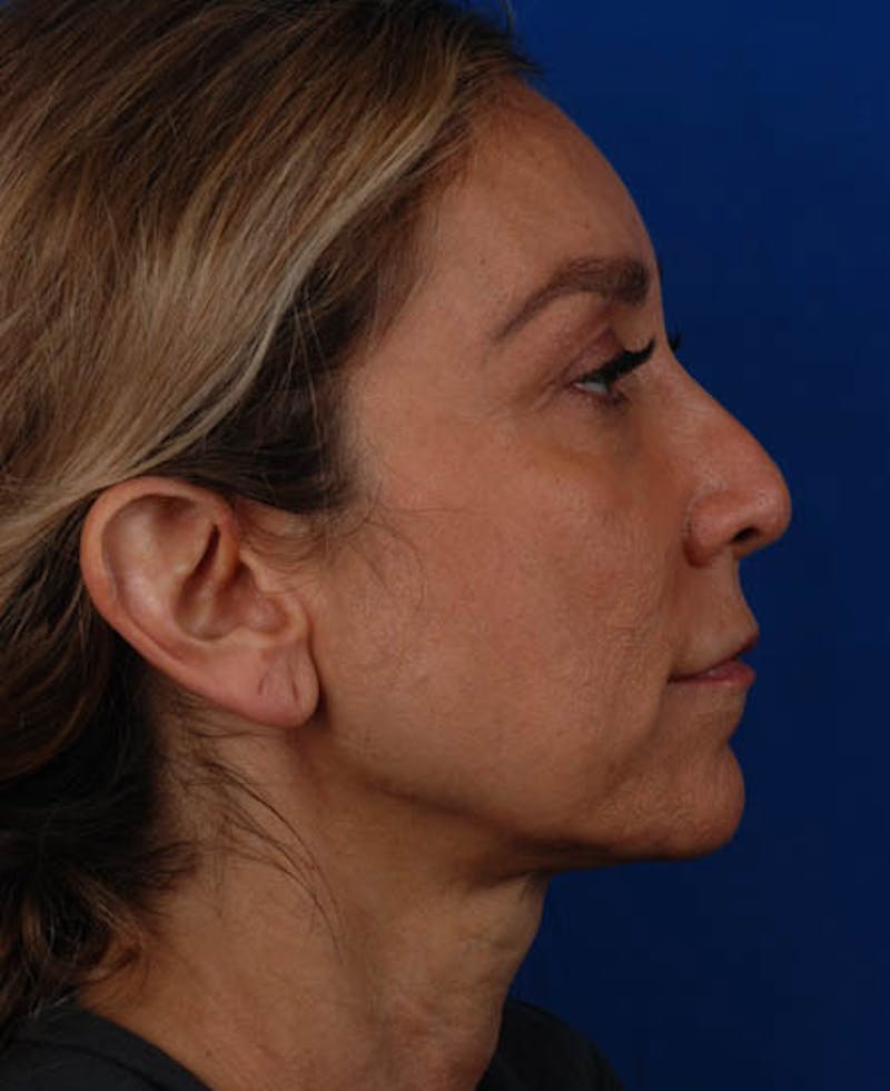 Facelift Before & After Gallery - Patient 12974003 - Image 7