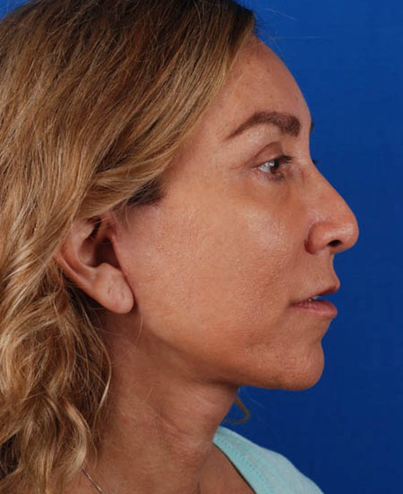Facelift Before & After Gallery - Patient 12974003 - Image 8