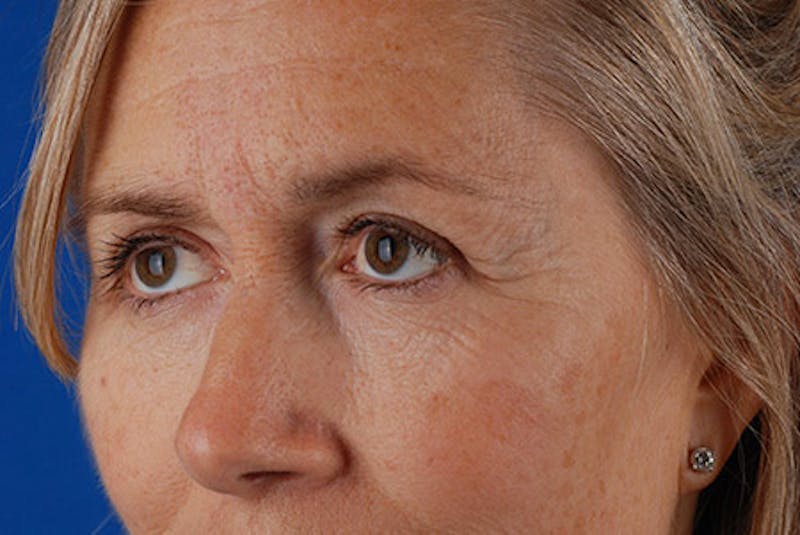 Brow Lift Before & After Gallery - Patient 12974004 - Image 3