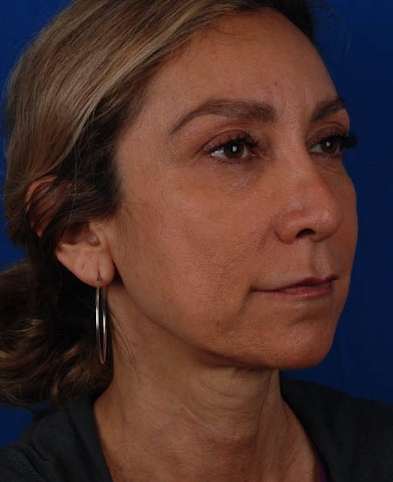 Facelift Before & After Gallery - Patient 12974003 - Image 9